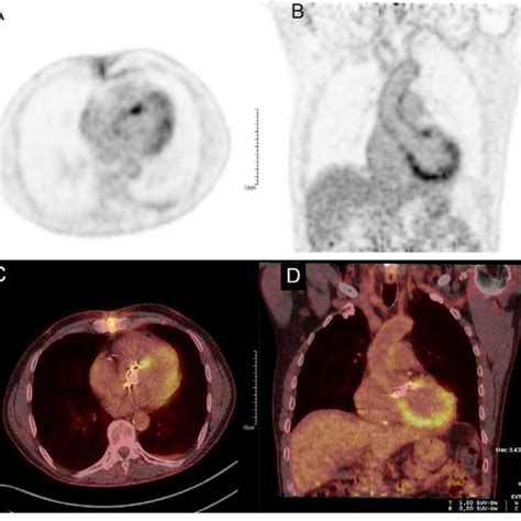 Attenuation Corrected F Fdg Pet Images A B And Fused Images C