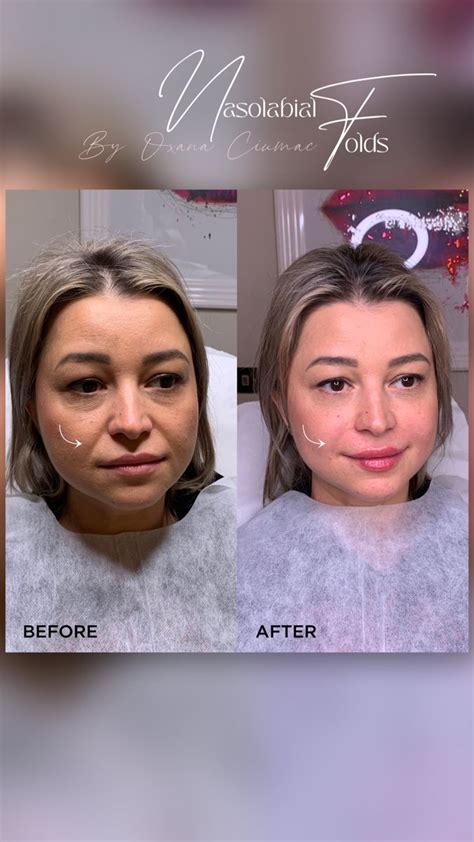 atartfaceclinic nasofold nasolabial fold filler nasolabial fold