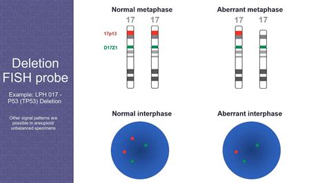 Chromosomal Aberrations Detected By FISH YouTube