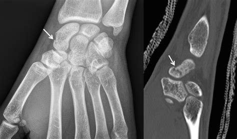 Fractures et pseudarthroses du scaphoïde Clinique Ostéo Articulaire