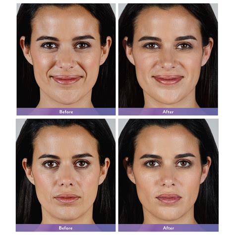 Facial Filler Before And After Feel Ideal Med Spa Southlake Tx