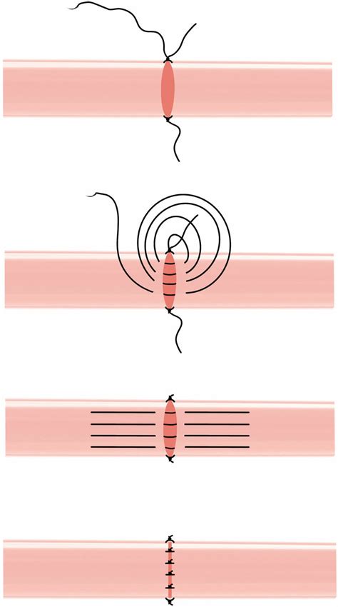 Illustration of the continuous-interrupted suture technique. | Download ...