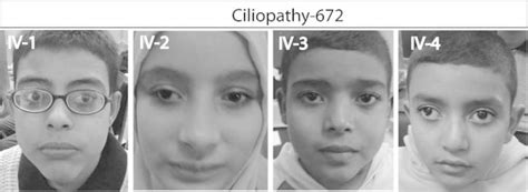 Facial appearance of affected members from Ciliopathy-672, showing ...