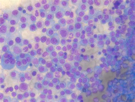 [figure Bone Marrow Aspirate With Plasma ] Statpearls Ncbi Bookshelf