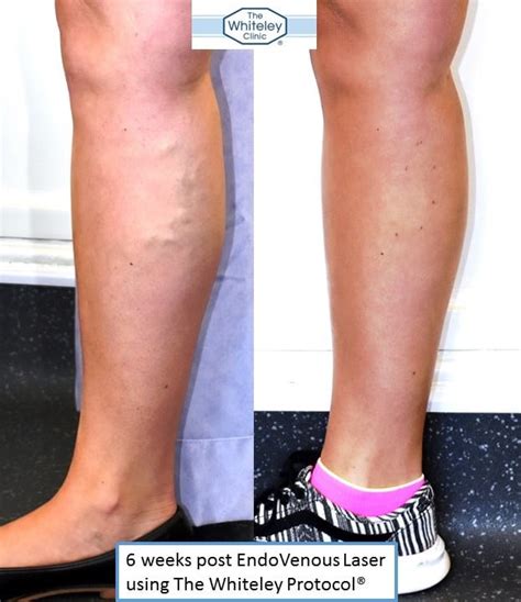 Right Calf Varicose Veins Treated By Endovenous Laser