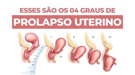 Os Graus De Prolapso Uterino Youtube