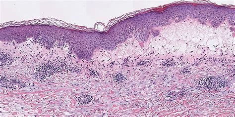 Tender Diffuse Edematous And Erythematous Papules On The Face Neck Chest And Extremities