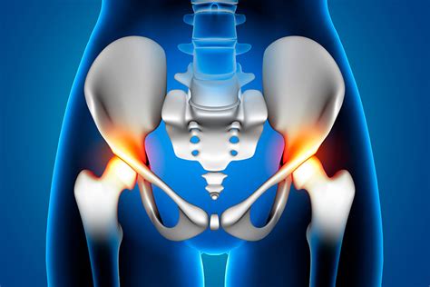 Traumatología infantil Enfermedad de Legg Calvé Perthes