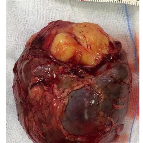 Gross Appearance Of The Excised Tumor Showing Smooth Surface Intact