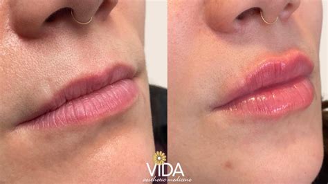 Injectables Photos VIDA Aesthetic Medicine Salem Oregon