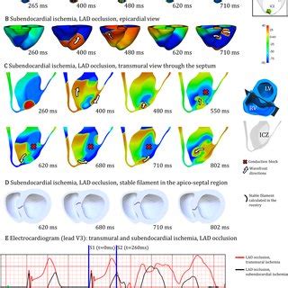 Human Torso Biventricular Electrophysiology Model In Acute Regional