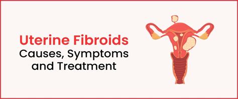 Uterine Fibroids Causes Symptoms Treatment Imprimis IVF