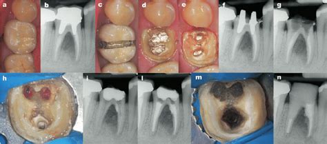 Preoperative Image A And Radiograph B Of A Mandibular First