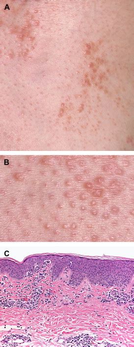 Papular Mycosis Fungoides A New Clinical Variant Of Early Mycosis