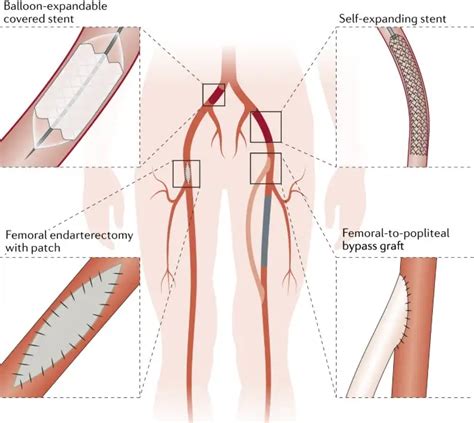 Abbott Atherectomy For Lower Extremity Revascularization User Guide