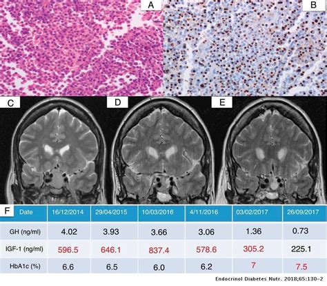 Pasireotide In Acromegaly By Aggressive Tumors Description Of Four