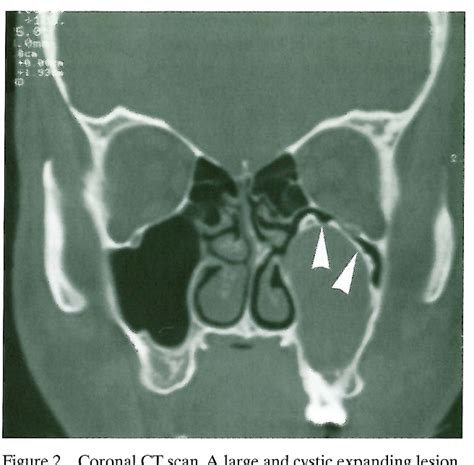 Odontogenic Keratocyst Of The Maxillary Sinus Semantic Scholar