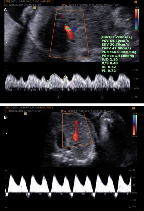 Flow Rate Waves On A Normal Ductus Venosus Doppler A And An Abnormal