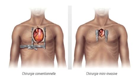 Chirurgie De L Aorte Chirurgie Cardiaque Prof Sotirios Marinakis