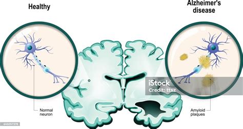 Ilustración De Enfermedad De Alzheimer Las Neuronas Y El Cerebro Y Más Vectores Libres De