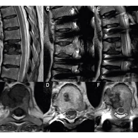 Spine Mri A B Sagittal T Weighted Dixon In Phase And Axial T