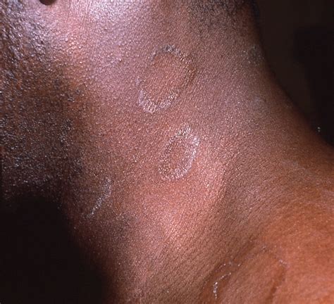 Ringworm On Black Skin