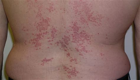 Erythematous Papular Rash