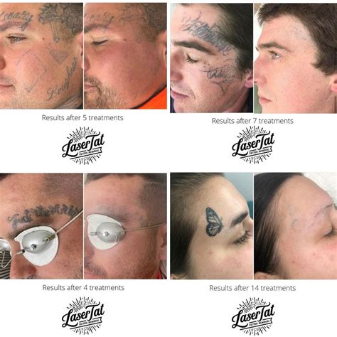 Discover More Than Laser Eyebrow Tattoo Removal Healing Process