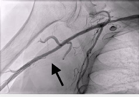 Angiogram Of The Right Upper Extremity Demonstrating Revascularization