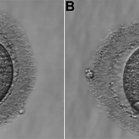 A Oocyte In Metaphase II B Oocyte MII Fertilized With 04 Pronuclei