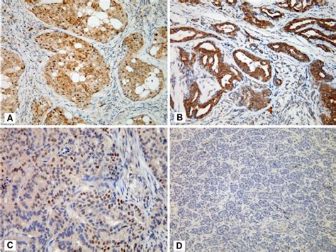 Beclin 1 Expression Patterns In Malignant Cmts A High Cytoplasmic