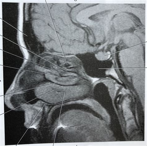 Sagittal T1 Mri Sphenoid Sinus Diagram Quizlet