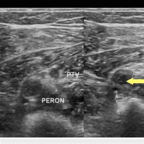 Left peroneal vein deep vein thrombosis (yellow arrow), axial view | Download Scientific Diagram