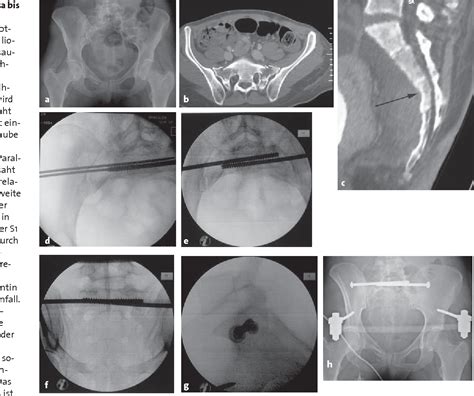 Figure From Percutaneous Iliosacral Screw Fixation Of Unstable Pelvic