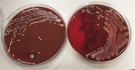 The Vitreous Sample Demonstrating A Heavy Growth Of Grampositive Cocci