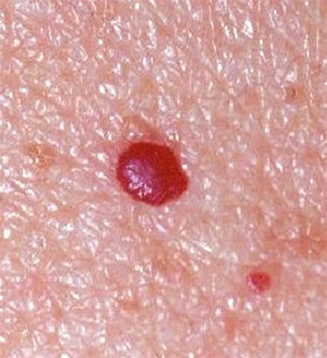 Cherry Angiomas Pictures Symptoms Causes Treatment Removal Healdove