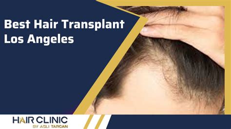 Best Hair Transplant Los Angeles Hairclinic By Aslı Tarcan