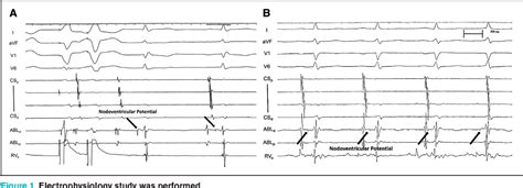 Figure 1 From Ablation Of Supraventricular Tachycardias From Concealed Left Sided