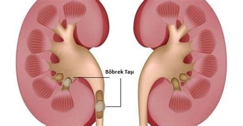 Böbrek Taşı Nasıl Oluşur Bilgi Vitrini