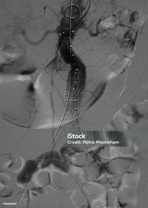 Endovascular Aneurysm Repair Procedure Stock Photo - Download Image Now ...