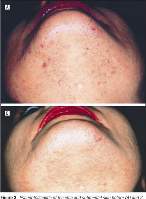 Figure From Treatment Of Pseudofolliculitis With A Pulsed Infrared