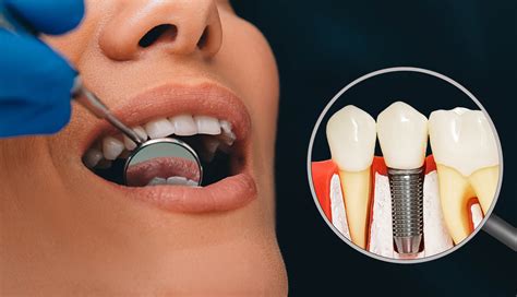 Implant Maintenance Smile Dental Implant Center