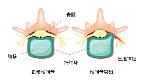 腰椎间盘突出能健身吗？如何健身是最好的方法？ 知乎