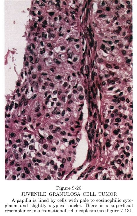 Pathology Outlines Granulosa Cell Tumor Juvenile