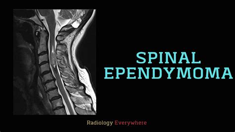 Spinal Ependymoma Radiology Tutorial Radiology Everywhere Youtube