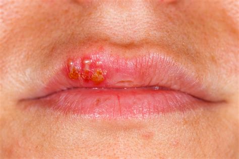 Are Cold Sores On The Lips Herpes Lipstutorial Org