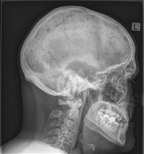 Multiple Myeloma Radiology Case Multiple Myeloma Myeloma Radiology