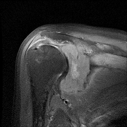 Chondrosarcoma Radiology Reference Article Radiopaedia Org