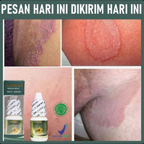 Obat Lecet Selangkangan Homecare