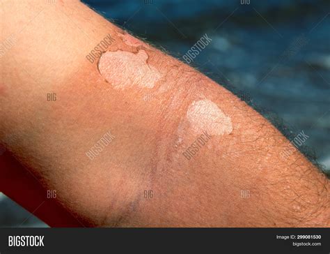 Sunburned Male Arm Image And Photo Free Trial Bigstock